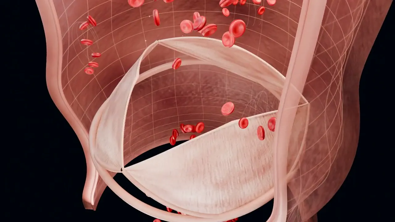 A cut-away aortic valve with its leaflets closing as red blood cells drift back