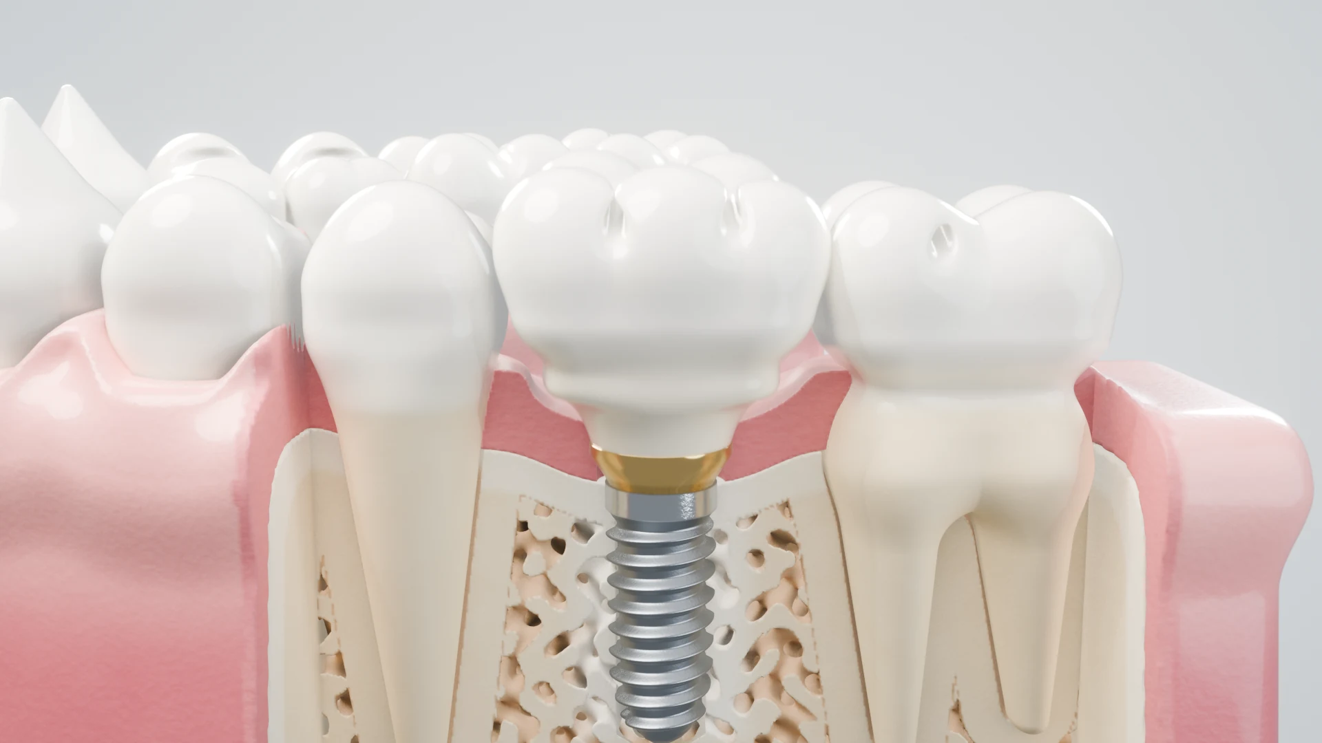 Full HD cut-away showing the finished crown on a gold connector and the implant in the bone