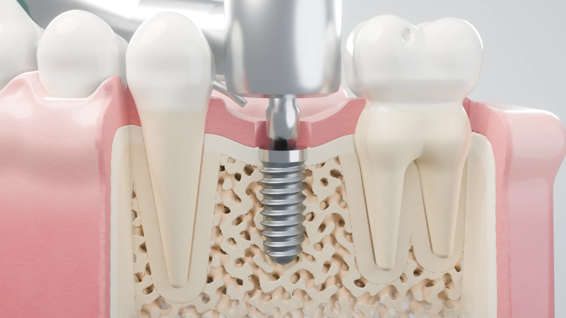 Full HD cut-away of the lower jaw as the driver places the titanium implant in the bone between two teeth